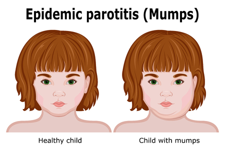 Little red-haired girl with mumps symptomsのイラスト素材
