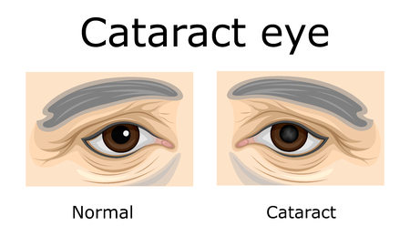 Comparison of a healthy eye and an eye with cataractsのイラスト素材