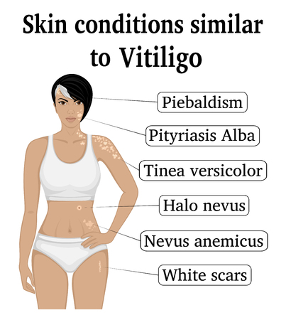 Six different skin conditions similar to Vitiligo, such as Tinea versicolor, Pityriasis Alba, Piebaldism, White scars, Nevus anemicus and Halo nevus.のイラスト素材