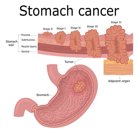 Five stages of the development of oncological disease - cancer of the stomachのイラスト素材