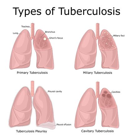 Illustration of different types of tuberculosis - primary, miliary, cavitary, pleurisyのイラスト素材