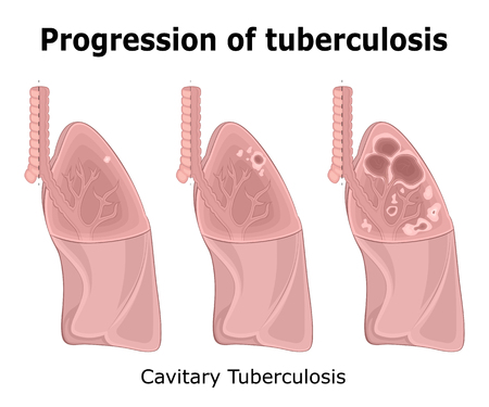 Illustration of the Progression of Cavitary Pulmonary Tuberculosisのイラスト素材