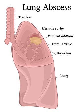 Illustration of a sectioned lungs depicting a purulent-necrotic cavity - an abscessのイラスト素材