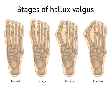 Three stages of valgus deformity of the big toeのイラスト素材