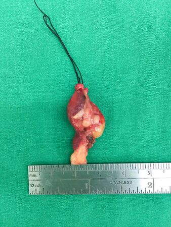 Tumor and stainless ruler on the green background