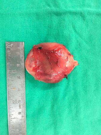 Tumor and stainless ruler on the green backgroundの写真素材