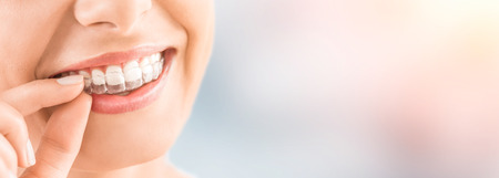 Woman wearing orthodontic silicone trainer. Invisible braces aligner. Mobile orthodontic appliance for dental correction.の写真素材