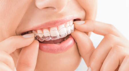 Woman wearing orthodontic silicone trainer. Invisible braces aligner. Mobile orthodontic appliance for dental correction.の写真素材