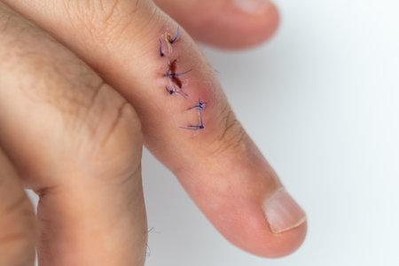 Stitched wound on a finger. Hand with stitched cut woundの写真素材