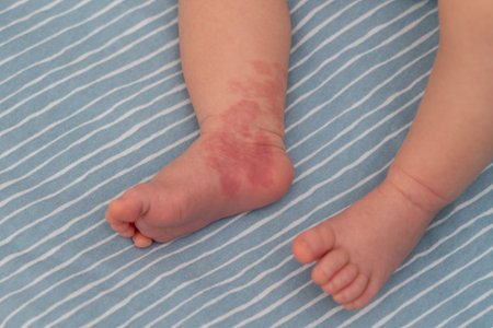 Hemangioma red birthmark on leg of newborn babyの写真素材