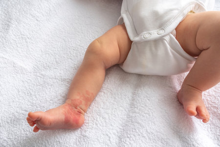 Hemangioma red birthmark on the leg of newborn babyの写真素材