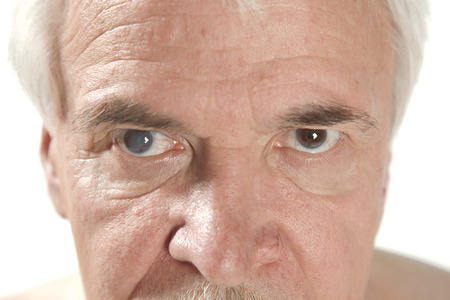 close up of the senile cataract during eye examinationの写真素材