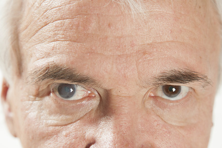 close up of the senile cataract during eye examinationの写真素材
