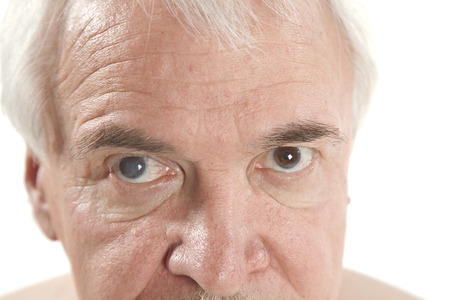 close up of the senile cataract during eye examinationの写真素材