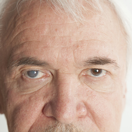 close up of the senile cataract during eye examinationの写真素材