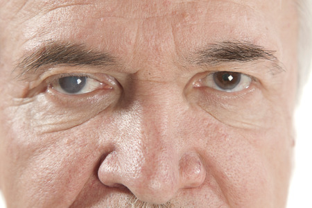 close up of the senile cataract during eye examinationの写真素材