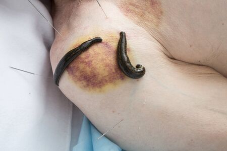 Treatment shoulder joint  of bloodletting, medical banks, acupuncture and leeches.の写真素材
