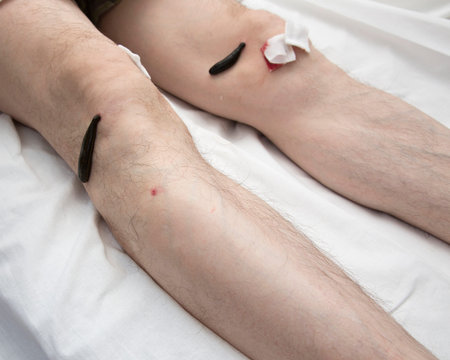 Treatment with leeches knee. Leech at Tsu-san-li - point of one hundred diseases.