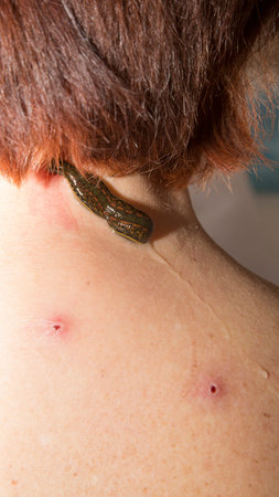 Treatment with leeches the neck and the back of an adult womanの写真素材