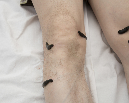 Treatment with leeches knee. Leech at Tsu-san-li - point of one hundred diseases.の写真素材