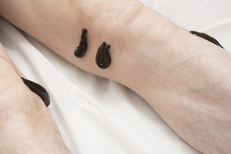 Treatment with leeches knee. Leech at Tsu-san-li - point of one hundred diseases.の写真素材