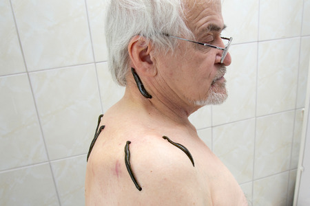 Treatment with leeches shoulder and neck area, back area in the middle of the right and left shoulder girdleの写真素材