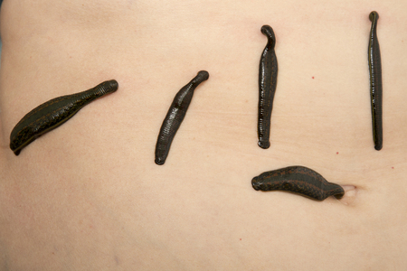 Leeches on his stomach in the liver area and the navel.の写真素材