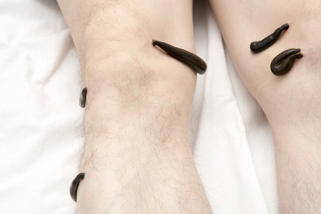 Treatment with leeches knee. Leech at Tsu-san-li - point of one hundred diseases.の写真素材