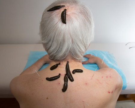 Treatment of headache, activity, dizziness, tinnitus medical leeches.