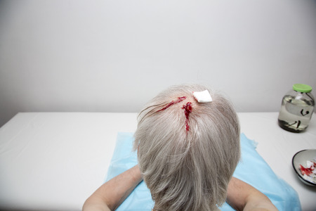 Treatment of headache, activity, dizziness, tinnitus medical leeches.の写真素材