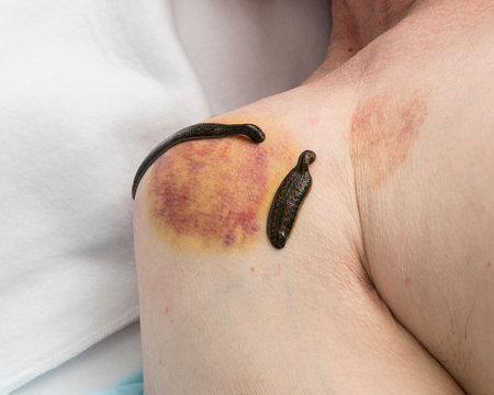 Treatment shoulder joint  of bloodletting, medical banks, acupuncture and leeches.