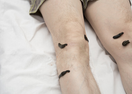 Treatment with leeches knee. Leech at Tsu-san-li - point of one hundred diseases.の写真素材