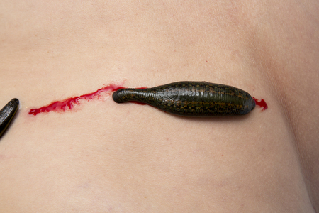 Leeches on his stomach in the liver area and the navel.の写真素材