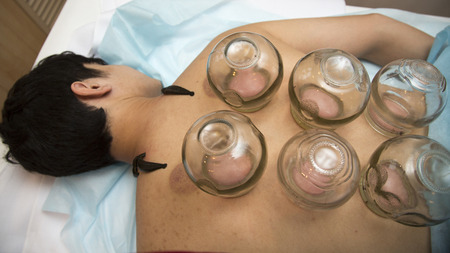 Multiple vacuum cup of medical cupping therapy on  hirudo medicinalis human body.
Hematoma after removing medical cansの写真素材