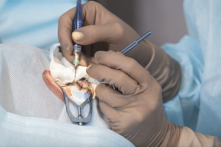 Lasik - laser correction for vision - ophthalmology surgery for eyesの写真素材