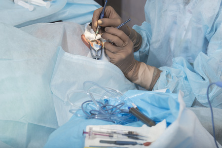 Phacoemulsification, destruction of the opaque lens by ultrasound, ophthalmic eye surgery. eye lens replacement, intraocular lens installation, surgical cataract treatment in Russia in Ulan-Ude.の写真素材