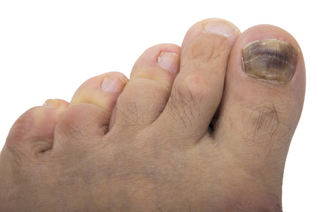 Fungal infection on the human toe. Psoriasis on the foot of an old man. Onychomycosis is a fungal infection of the big toe. Nail melanoma.の写真素材