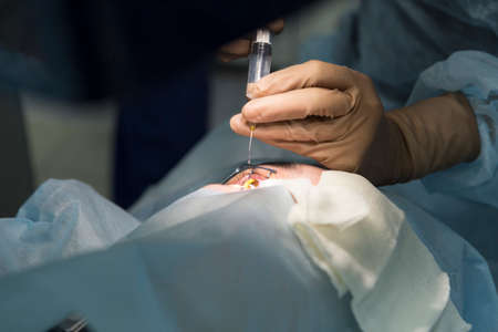Laser surgery for vision correction and cataract removalの写真素材