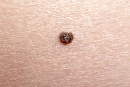 The first signs of melanoma or squamous keratinizing skin cancer. Nevus before surgery to remove it.の写真素材