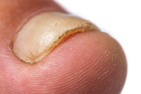 Toe nail with psoriasis and healthy toe nails, Psoriatic nail, close-upの写真素材