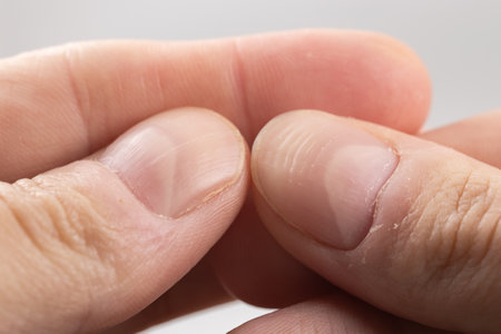 Ridged fingernails with vertical and horizontal ridges. Nails problemsの写真素材