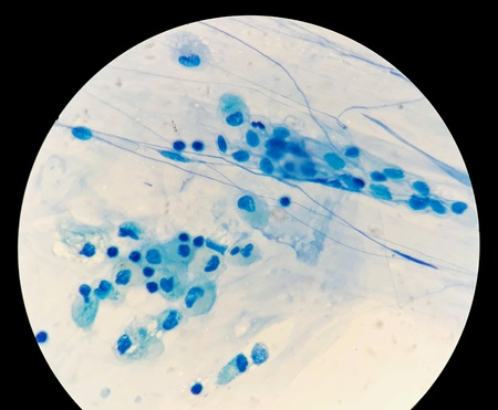 Smear of Acid-Fast bacilli AFB stained from sputum specimen, under 100X light microscope.の素材