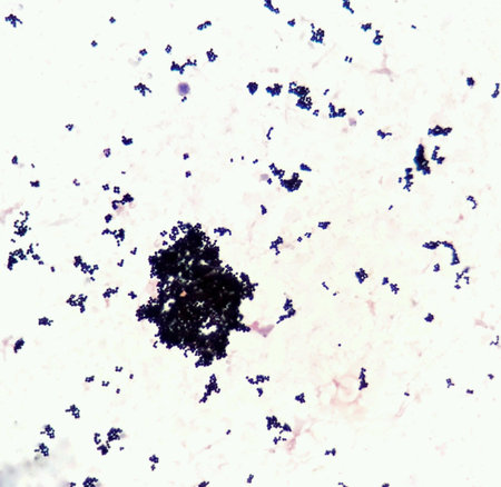 Hemocultured smear of gram positive cocci in cluster bacteria,under 100X light microscope.