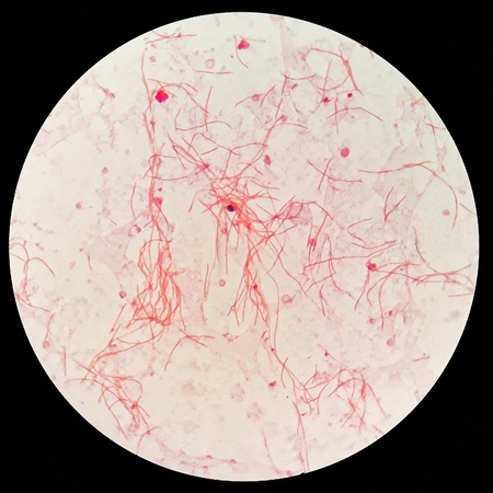 Smear of human blood cultured Gram' s stained with gram negative bacilli bacteria.の素材