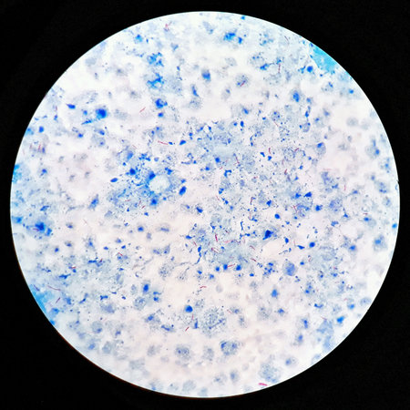 Smear of positive Acid-Fast bacilli AFB bacteria stained, under 100X light microscope.
