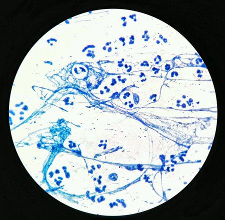 Smear of Acid-Fast bacilli AFB stained with WBC and mucous, under 100X light microscope.