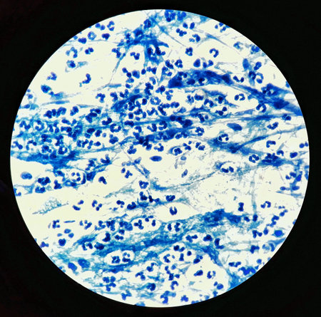 Smear of Acid-Fast bacilli AFB stained with WBC and mucous, under 100X light microscope.