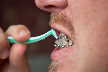 Adult man with a beard and mustache brushes his teeth with braces by interdental brush. Side view