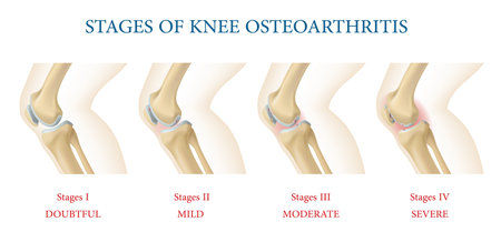 Medical infographics. Knee joint osteoarthritis stages, vector chart of human body anatomy with knee bones, healthy and thinned cartilage. Joint pain, inflammation symptoms of osteoarthritis diseaseのイラスト素材