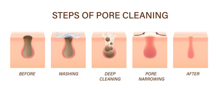 Skin pores cleaning steps for face acne and facial cleanser treatment, vector process. Skin care foam cleaner for blackhead and dirty cells clogged with sebum, pores cleaning infographic for cleanserのイラスト素材